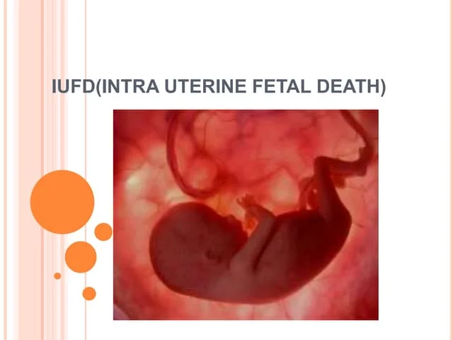 Understanding IUFD